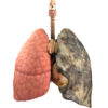 Lung Disease Before and After