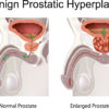 Benign prostatic hyperplasia (prostatic hypertrophy)